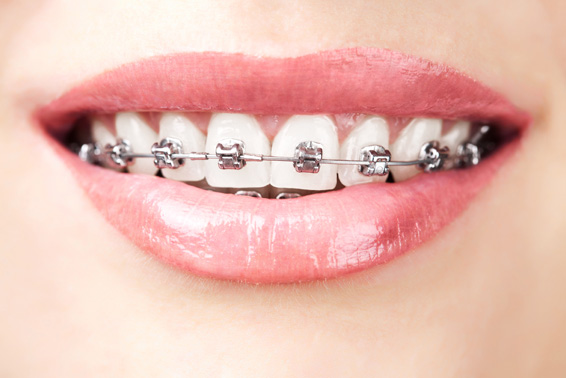 ortodoncia-tratamientos-clinica-dental-tierra-estella
