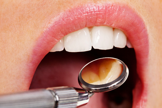 periodoncia-tratamientos-clinica-dental-tierra-estella