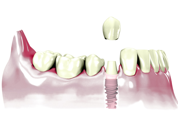 implantes-tratamientos-clinica-dental-tierra-estella
